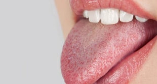 أسباب جفاف الفم
